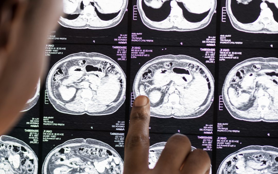 Batea Oncology– Proyecto GlioProof