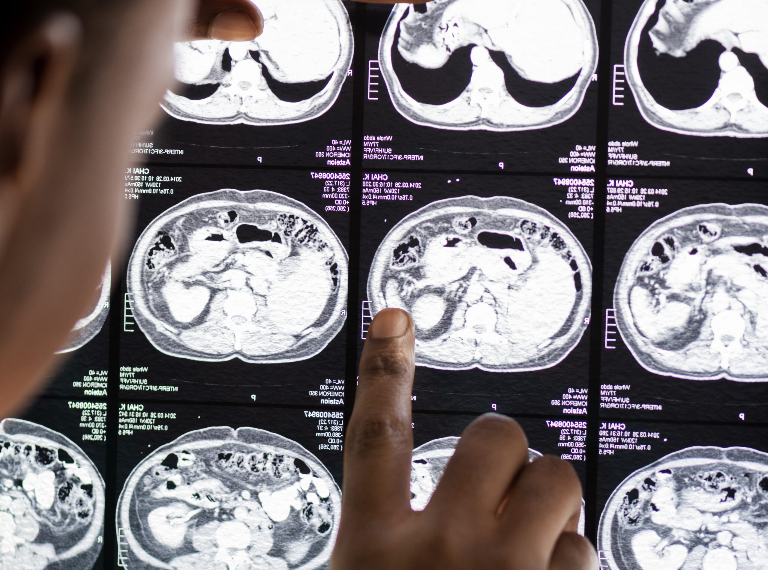 Batea Oncology– Proyecto GlioProof